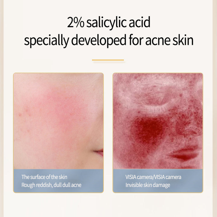 The Porefect Serum - Salicylic Acne Essence