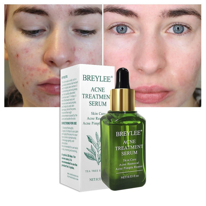 Camellia Sinensis Leaf Extract Anti-Acne Serum